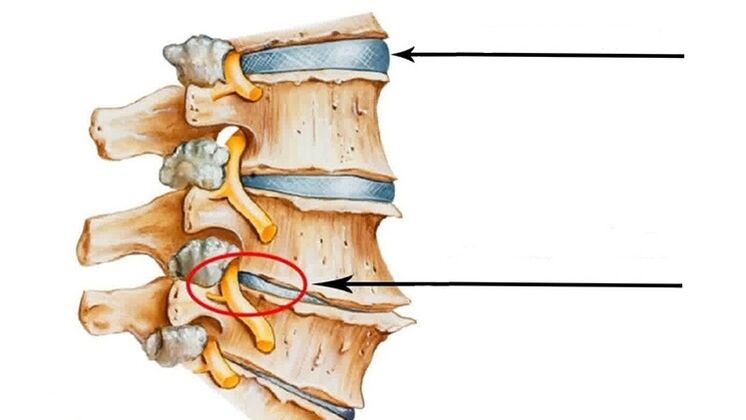 spinal injuries in the case of cervical osteochondrosis