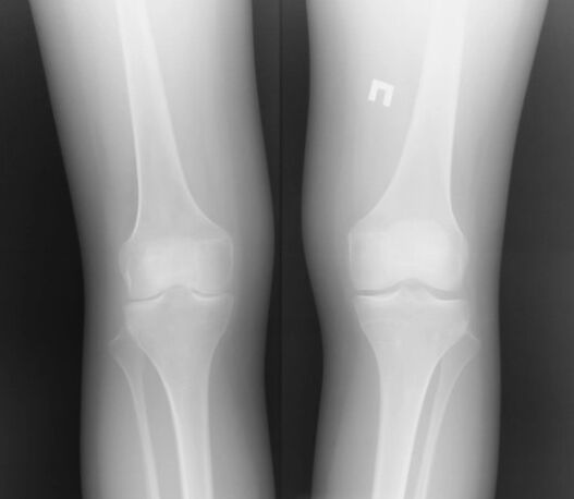Radography of the knee wrist