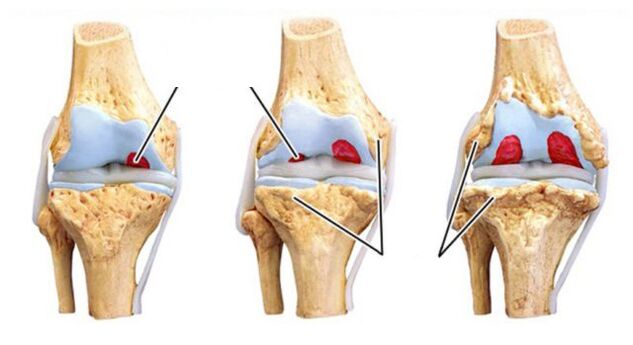 Complications of arthrosis joints