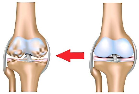 Healthy wrist and arthrosis