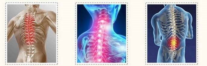 OsteoHondrosis Spinal lesions